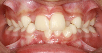 Invisalign