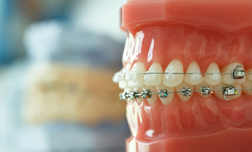 How Much Do Braces Cost In Queensland? Your Guide To Affordable Smiles How Much Do Braces Cost In Queensland? Your Guide To Affordable Smiles